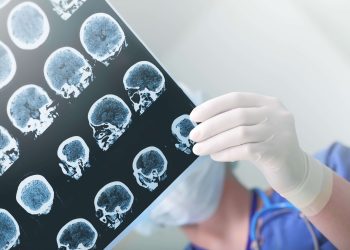 Neuróloga llama estar alerta síntomas ACV