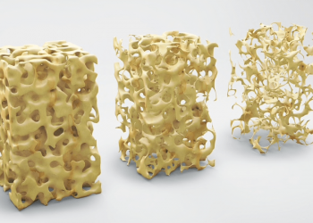 Reumatóloga destaca medio detección osteoporosis
