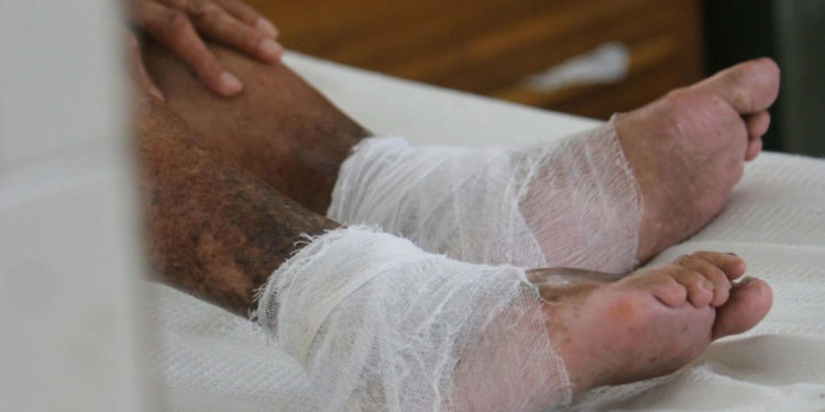 Dermatóloga alerta sobre efectos lepra