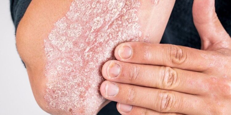 Especialistas dan recomendaciones Día del ACV y la Psoriasis